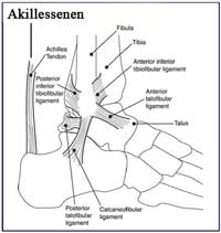 Akillessenebetændelse