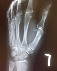 brækket håndled