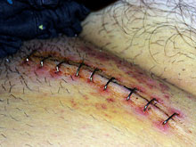 En brokoperation hos en patient
