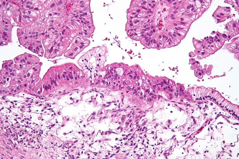 En mens uge udflåd brunt før Menstruation