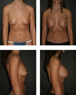 Billeder af en brystforstørrende operation