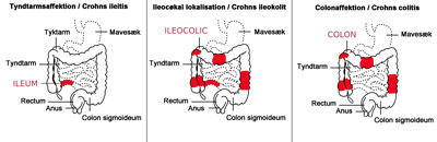 crohns sygdom - tarme