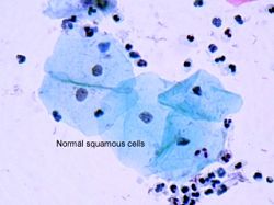 Almindelige celler uden dysplasi