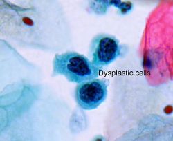 Forandrede celler ved dysplasi