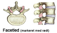 facetledssyndrom