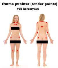 Fibromyalgi - symptomer