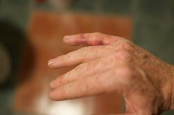 En forstuvet finger