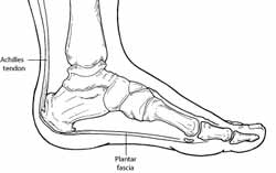 hælsmerter og Plantar Fasciitis