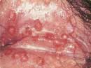 herpes i skeden
