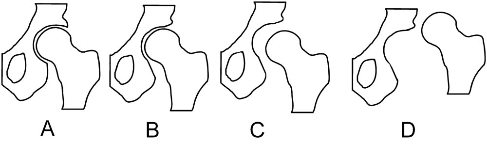 Hoftedysplasi - Årsager, symptomer, osv.