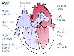 hul i hjertet - ventrikelseptumdefekt