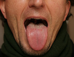 Her ses en belægning på tungen