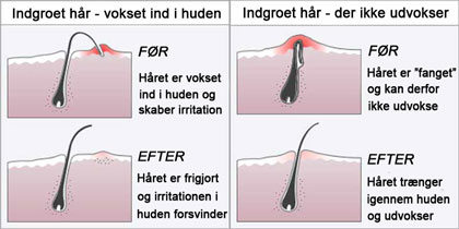 2 typer indgroet hår
