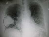 Lungebetændelse