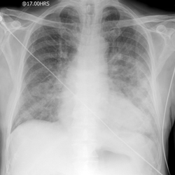 lungeødem - røntgenbillede