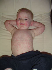 Lussingesyge kaldes også 'den femte børnesygdom' og medfører rødt udslæt på kinderne