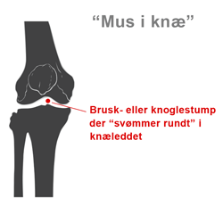 Mus i knæ er en knæskade