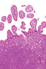 non-hodgkins lymfom