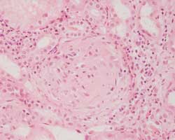 Nyrebetændelse kaldes også glomerulonefritis på fagsprog