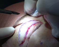 Øjenlågsoperation hos en patient