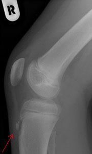 osgood schlatter sygdom