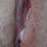 pilonidalcyste