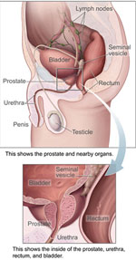 Prostatakræft