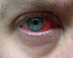 Røde øjne skyldes typisk blodsprængninger