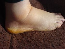Her ses vand i benene