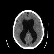 Vand i hovedet (hydrocephalus) hos et menneske